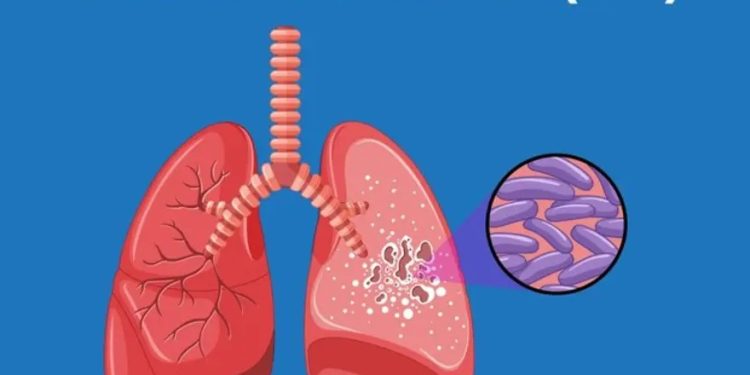 GLOBAL TUBERCULOSIS FIGHT, Prevention, Eradication, St. George’s University