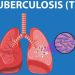 GLOBAL TUBERCULOSIS FIGHT, Prevention, Eradication, St. George’s University
